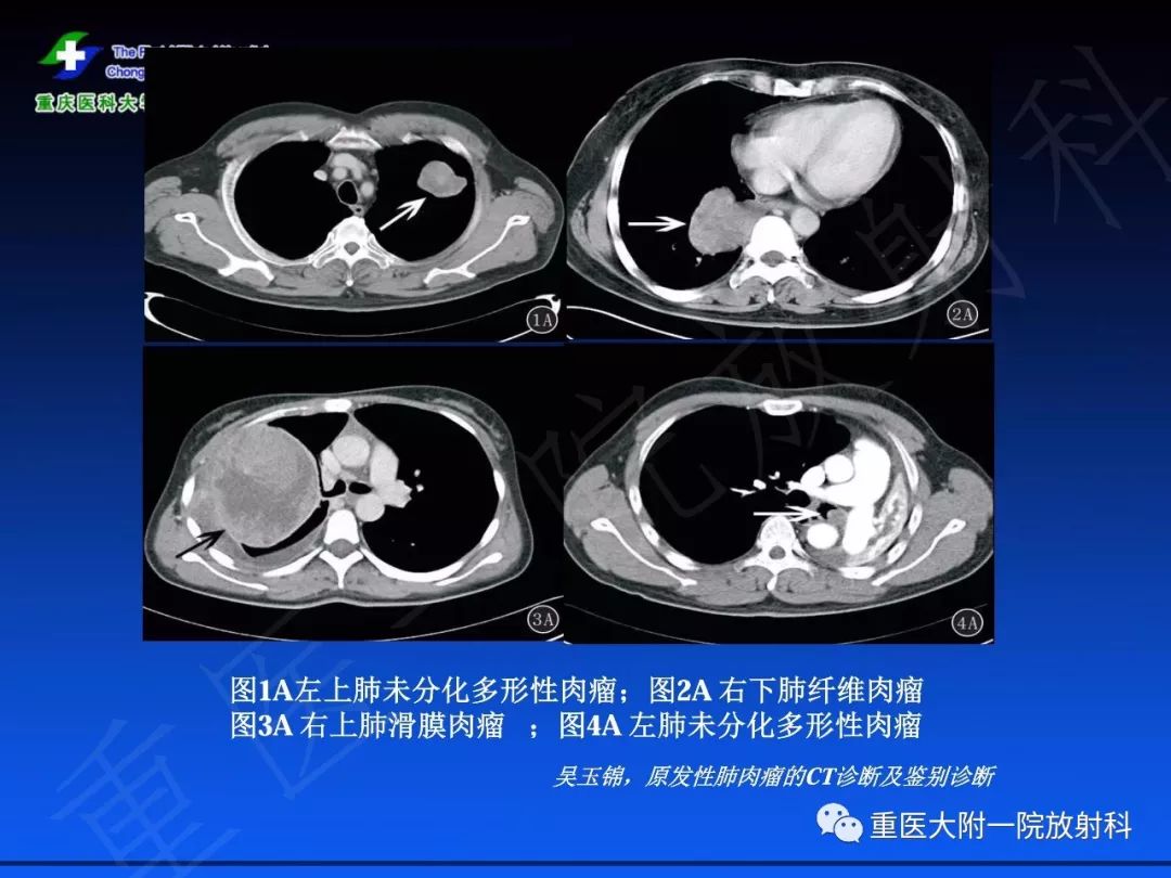 影像PPT - 【PPT】孤立性纤维瘤的影像学诊断及鉴别诊断-20