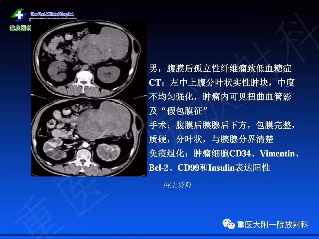 影像PPT - 【PPT】孤立性纤维瘤的影像学诊断及鉴别诊断-23