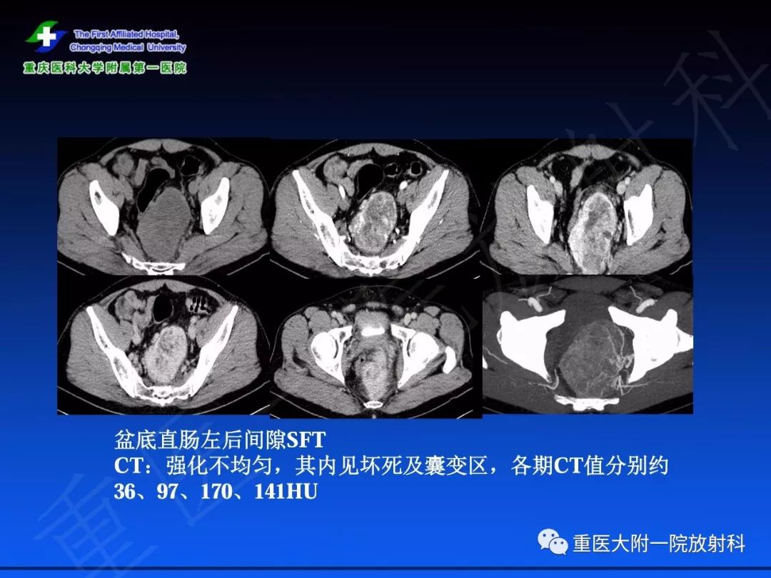 影像PPT - 【PPT】孤立性纤维瘤的影像学诊断及鉴别诊断-26