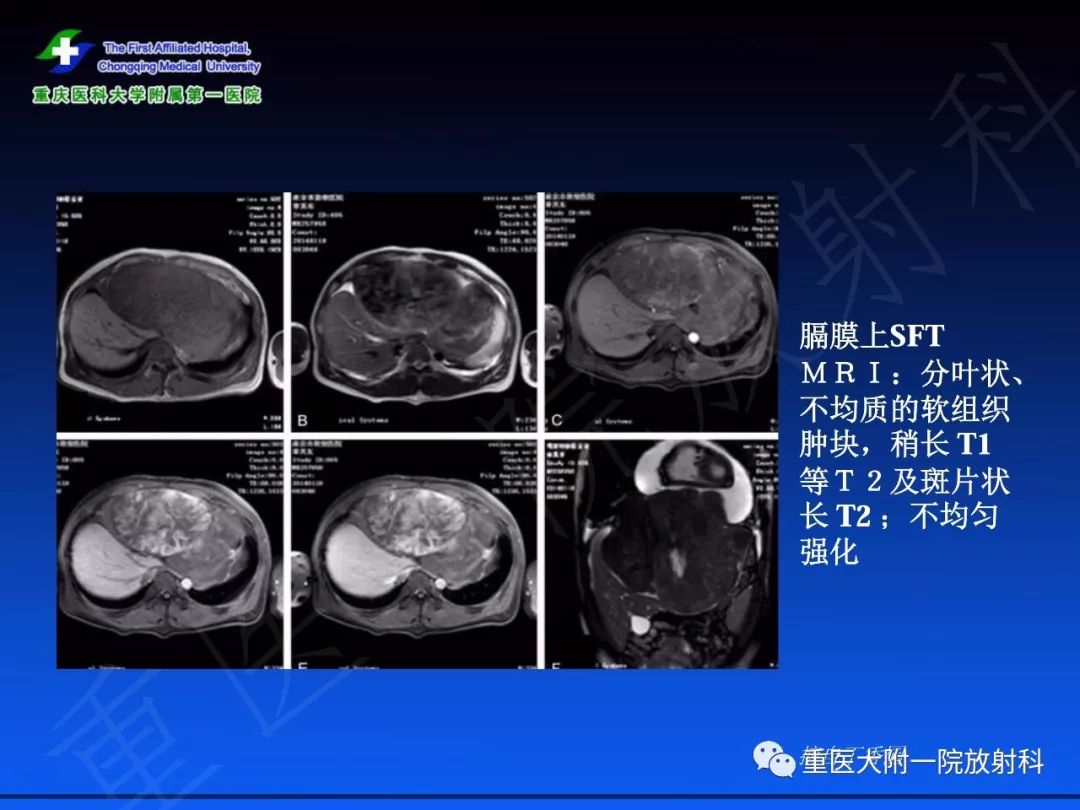 影像PPT - 【PPT】孤立性纤维瘤的影像学诊断及鉴别诊断-25