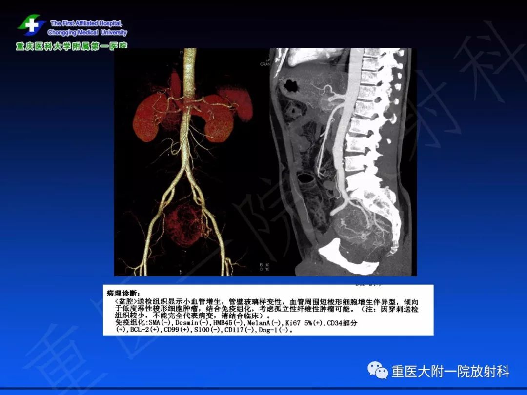 影像PPT - 【PPT】孤立性纤维瘤的影像学诊断及鉴别诊断-27