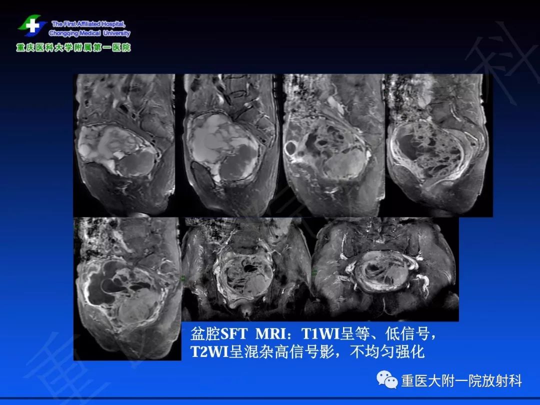 影像PPT - 【PPT】孤立性纤维瘤的影像学诊断及鉴别诊断-28