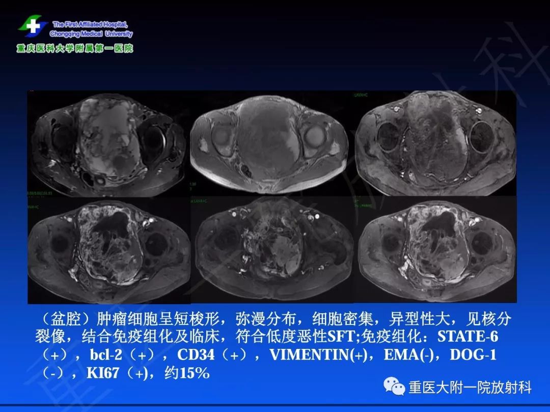 影像PPT - 【PPT】孤立性纤维瘤的影像学诊断及鉴别诊断-29