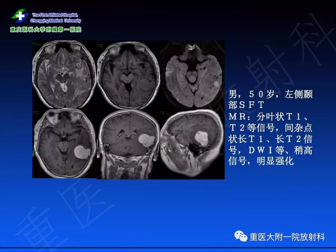 影像PPT - 【PPT】孤立性纤维瘤的影像学诊断及鉴别诊断-34