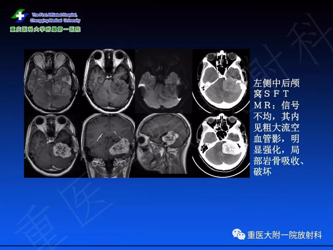 影像PPT - 【PPT】孤立性纤维瘤的影像学诊断及鉴别诊断-35