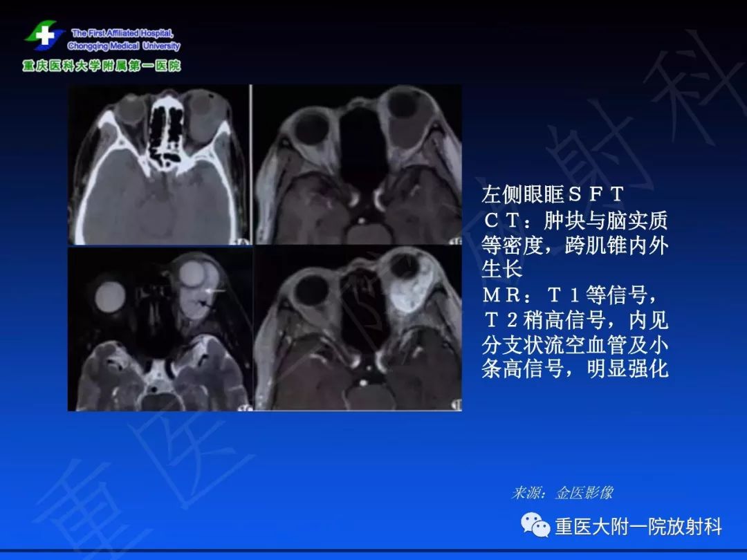 影像PPT - 【PPT】孤立性纤维瘤的影像学诊断及鉴别诊断-41