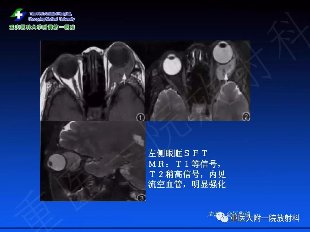 影像PPT - 【PPT】孤立性纤维瘤的影像学诊断及鉴别诊断-42