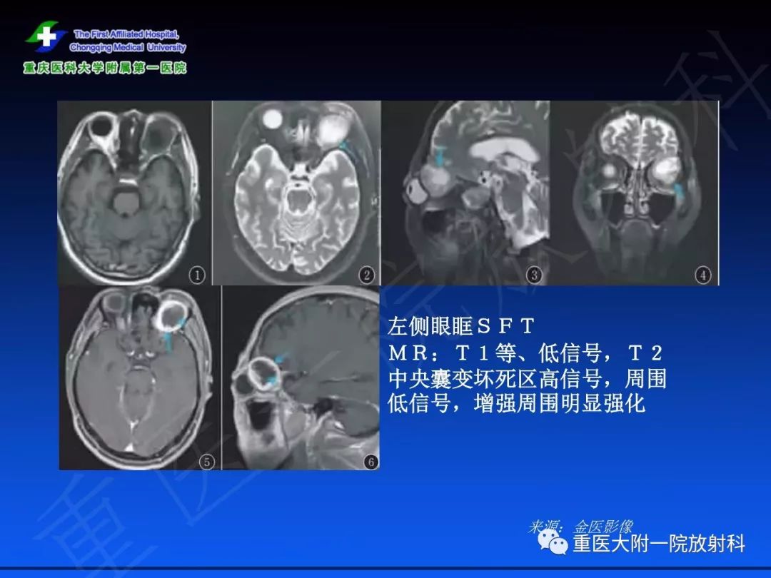 影像PPT - 【PPT】孤立性纤维瘤的影像学诊断及鉴别诊断-43