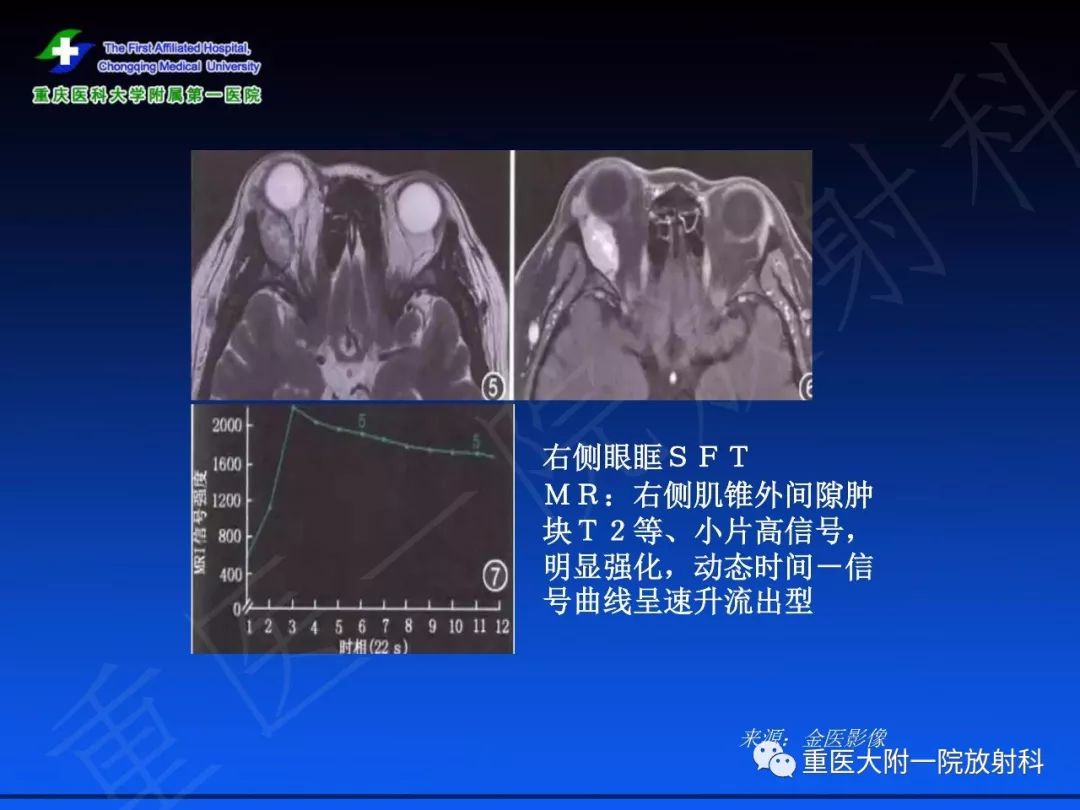 影像PPT - 【PPT】孤立性纤维瘤的影像学诊断及鉴别诊断-44
