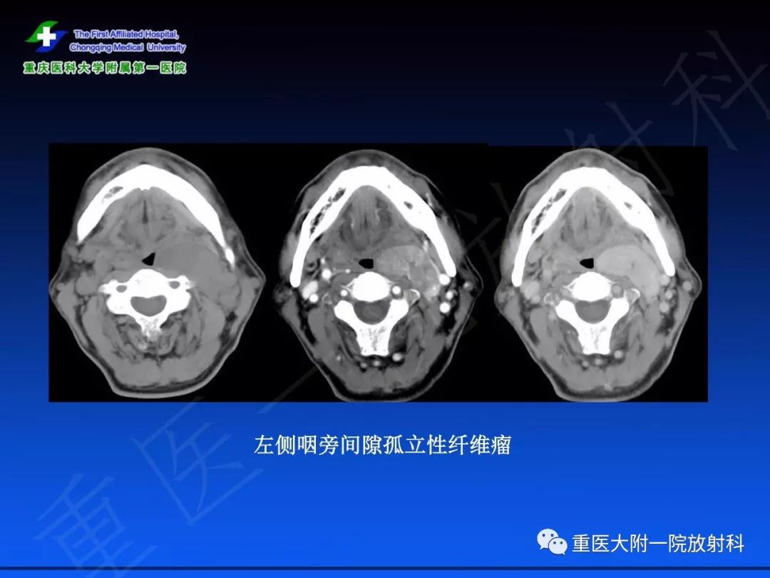 影像PPT - 【PPT】孤立性纤维瘤的影像学诊断及鉴别诊断-46