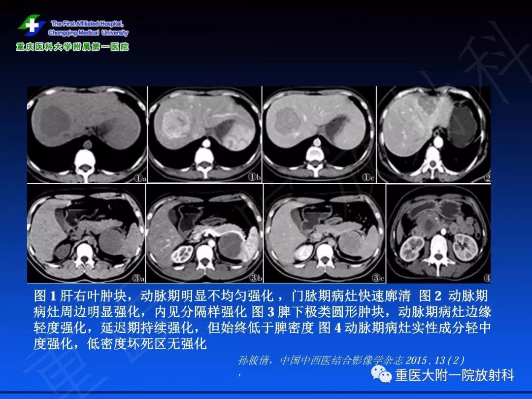 影像PPT - 【PPT】孤立性纤维瘤的影像学诊断及鉴别诊断-51