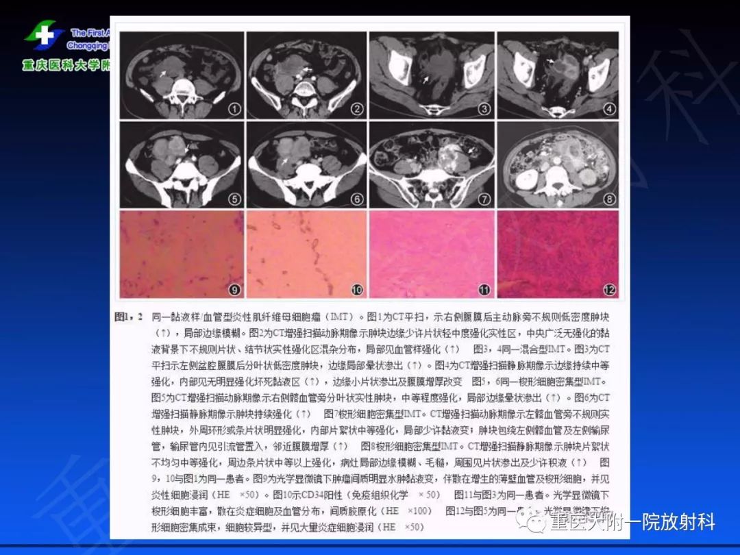 影像PPT - 【PPT】孤立性纤维瘤的影像学诊断及鉴别诊断-52