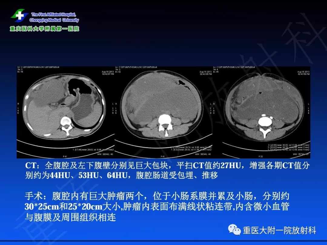 影像PPT - 【PPT】孤立性纤维瘤的影像学诊断及鉴别诊断-57