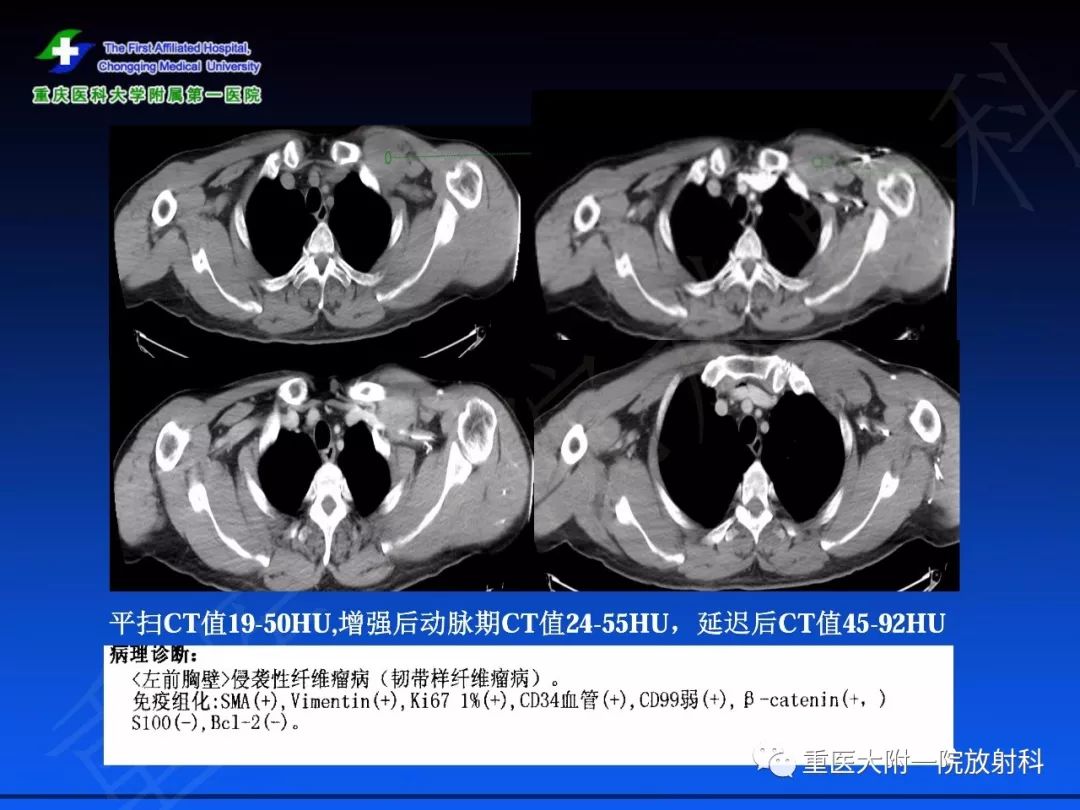 影像PPT - 【PPT】孤立性纤维瘤的影像学诊断及鉴别诊断-56