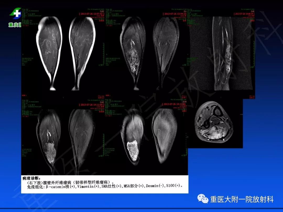 影像PPT - 【PPT】孤立性纤维瘤的影像学诊断及鉴别诊断-59