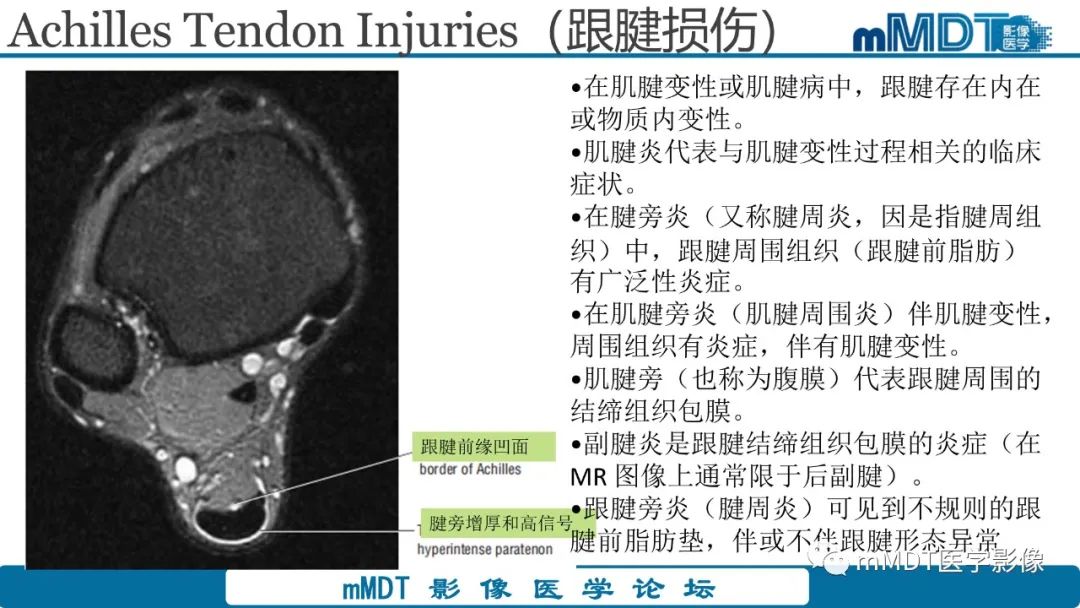 影像PPT - 【PPT】踝关节—跟腱损伤的影像分析-4 影像PPT - 【PPT】踝关节—跟腱损伤的影像分析-4