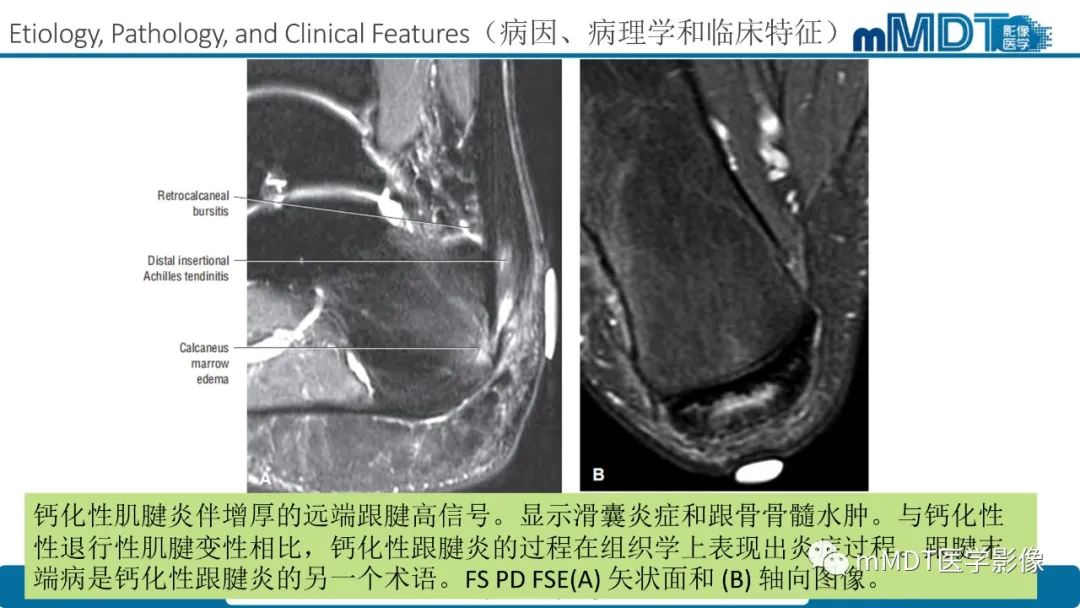 影像PPT - 【PPT】踝关节—跟腱损伤的影像分析-9 影像PPT - 【PPT】踝关节—跟腱损伤的影像分析-9