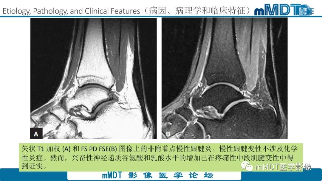 影像PPT - 【PPT】踝关节—跟腱损伤的影像分析-8 影像PPT - 【PPT】踝关节—跟腱损伤的影像分析-8