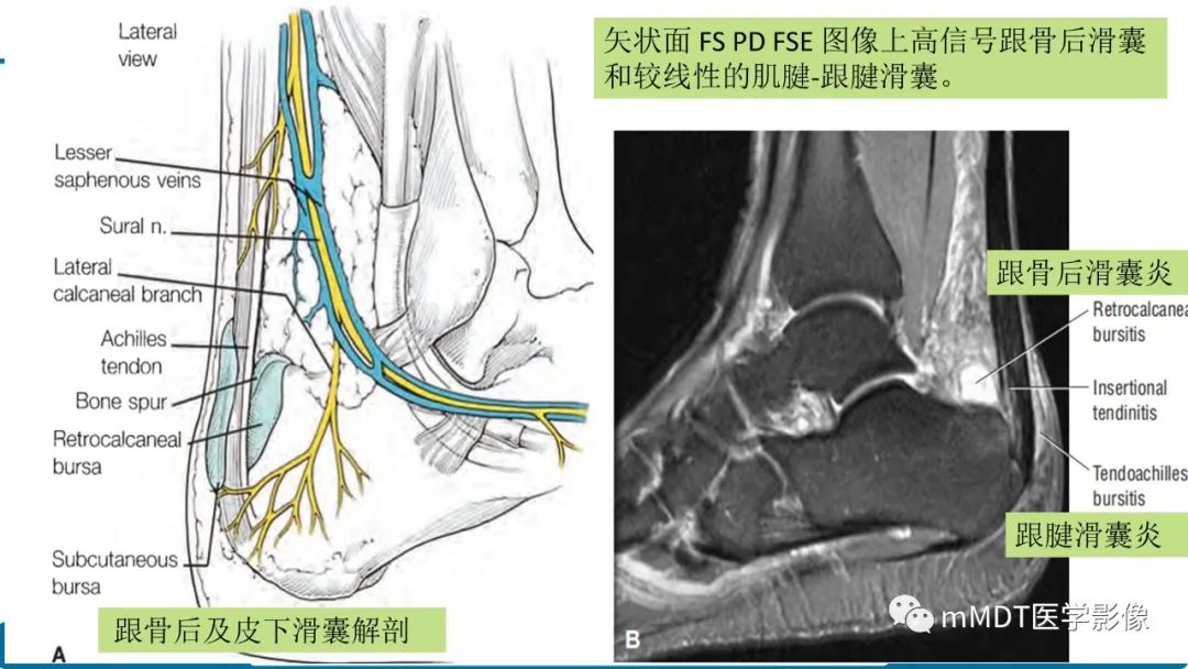 影像PPT - 【PPT】踝关节—跟腱损伤的影像分析-11 影像PPT - 【PPT】踝关节—跟腱损伤的影像分析-11