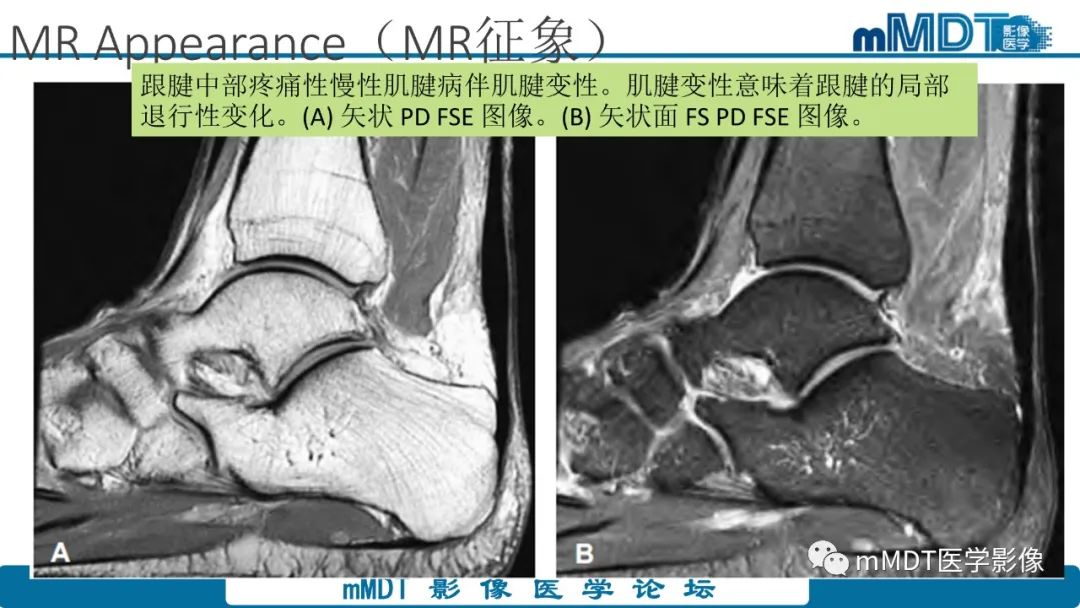 影像PPT - 【PPT】踝关节—跟腱损伤的影像分析-13 影像PPT - 【PPT】踝关节—跟腱损伤的影像分析-13