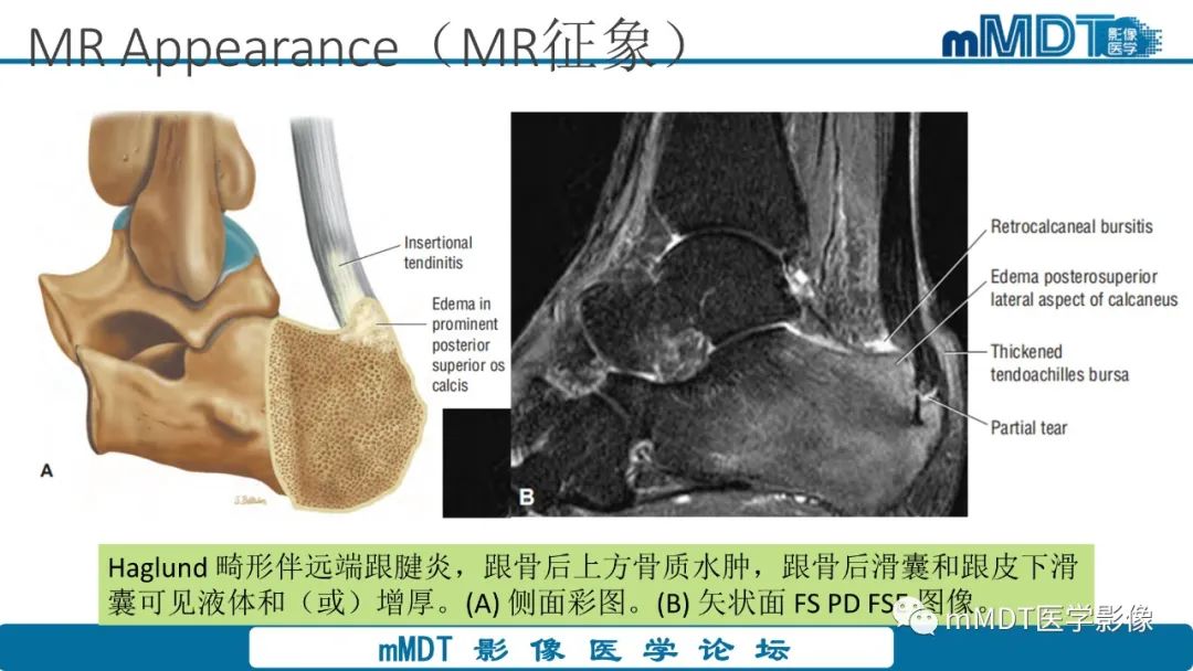 影像PPT - 【PPT】踝关节—跟腱损伤的影像分析-17 影像PPT - 【PPT】踝关节—跟腱损伤的影像分析-17