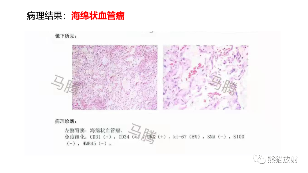 影像PPT - 【PPT】肾窦病变影像诊断思路-15