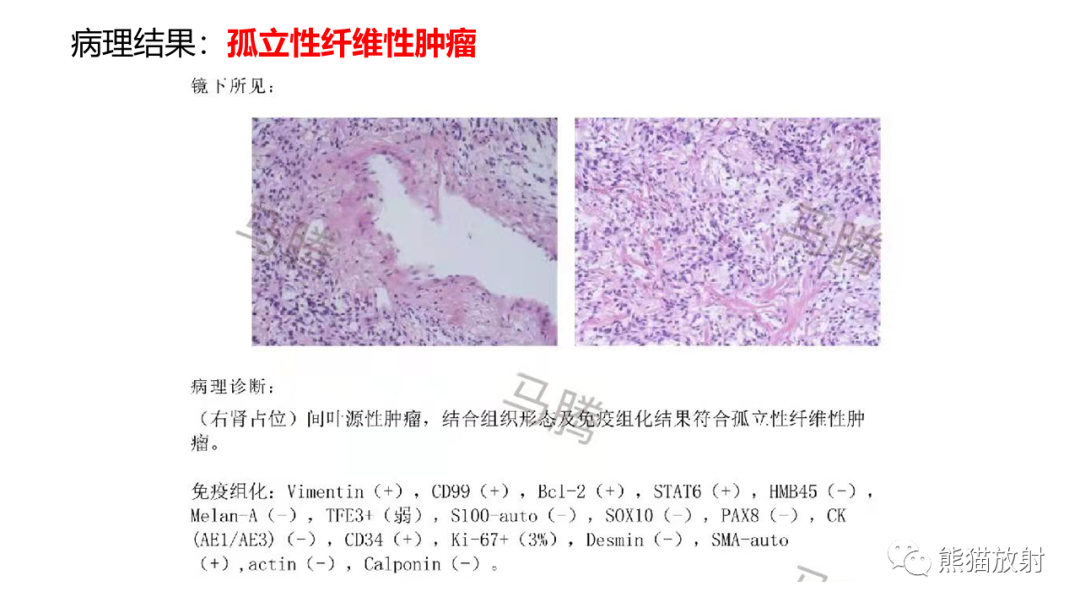 影像PPT - 【PPT】肾窦病变影像诊断思路-17