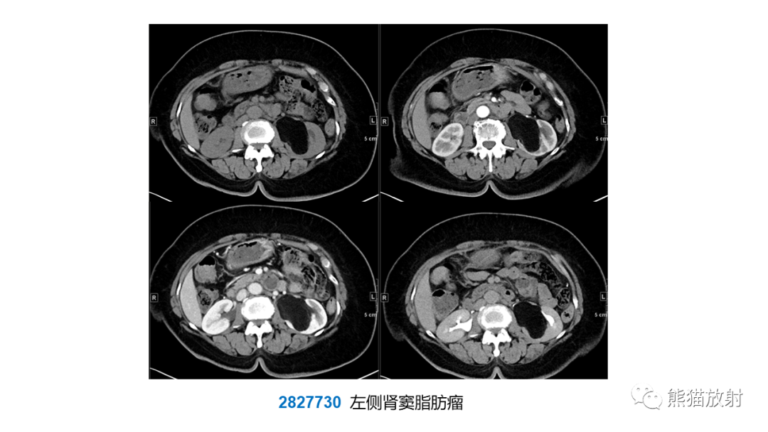 影像PPT - 【PPT】肾窦病变影像诊断思路-22