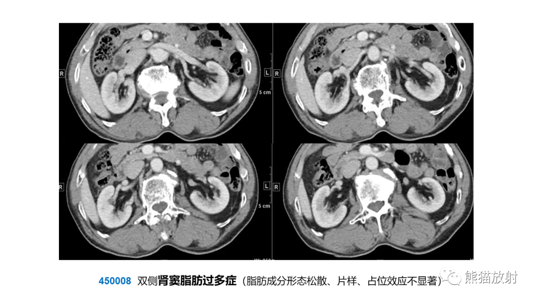 影像PPT - 【PPT】肾窦病变影像诊断思路-24