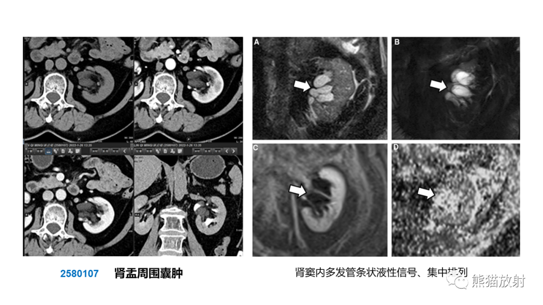 影像PPT - 【PPT】肾窦病变影像诊断思路-26