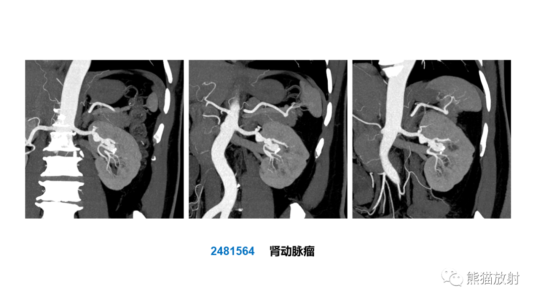 影像PPT - 【PPT】肾窦病变影像诊断思路-31