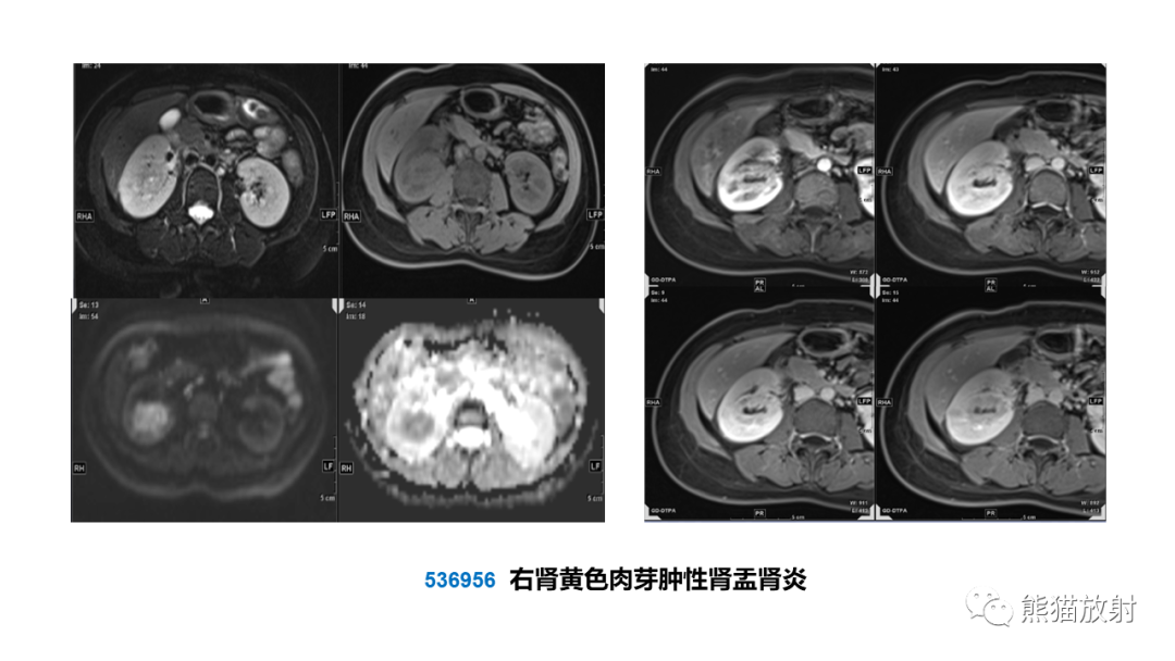 影像PPT - 【PPT】肾窦病变影像诊断思路-37