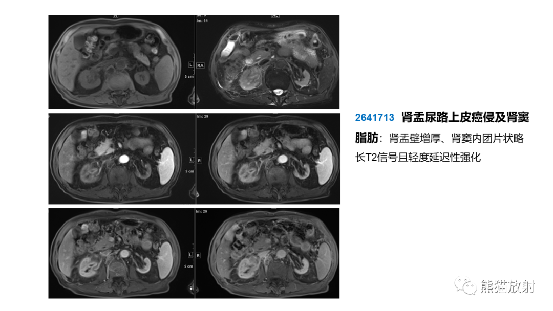 影像PPT - 【PPT】肾窦病变影像诊断思路-40