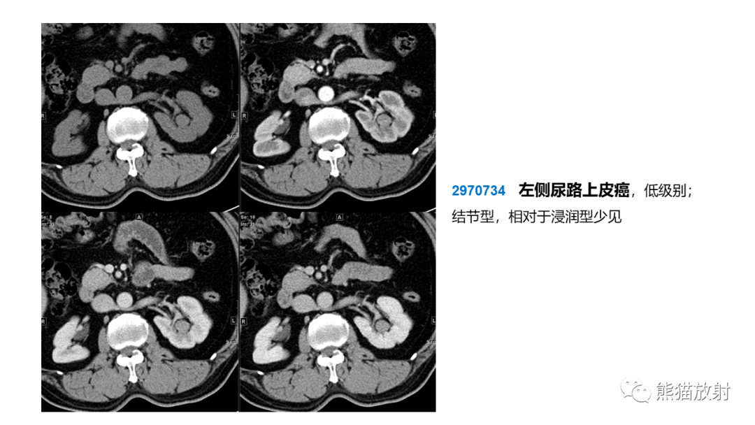 影像PPT - 【PPT】肾窦病变影像诊断思路-41