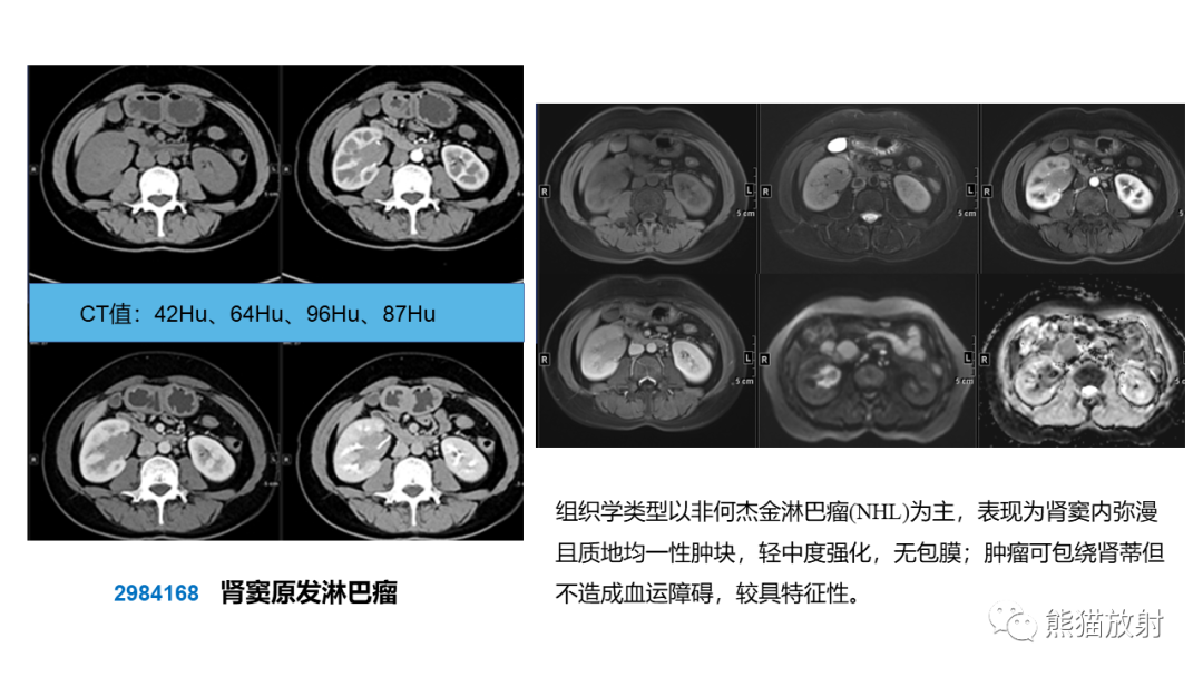 影像PPT - 【PPT】肾窦病变影像诊断思路-44