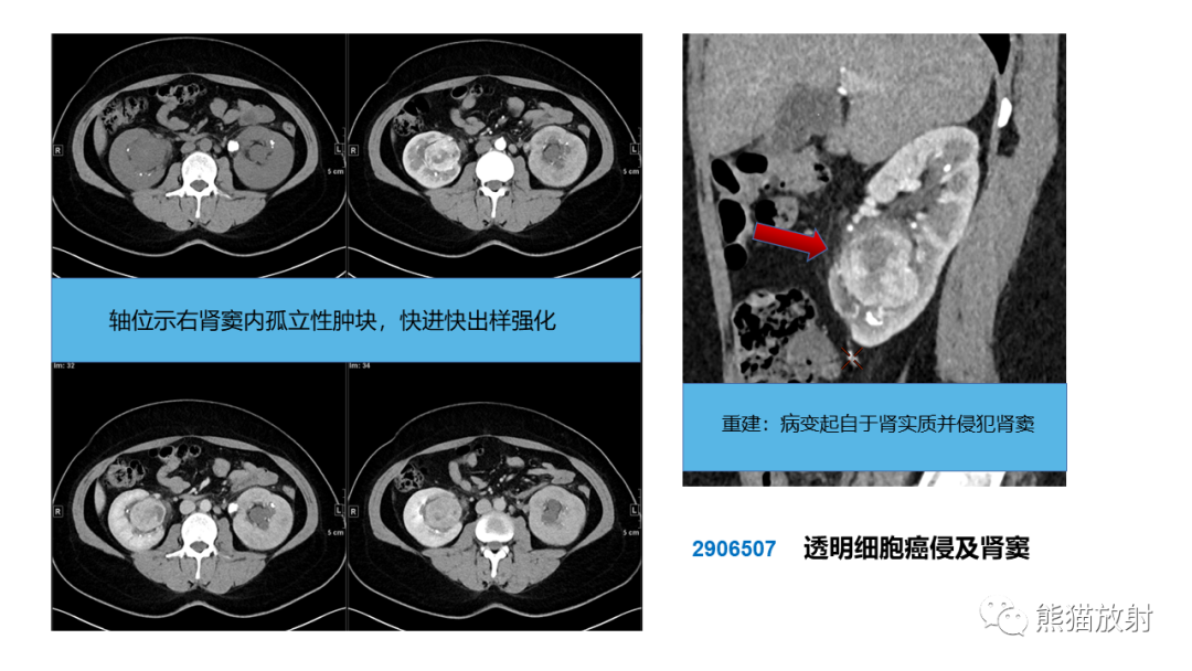 影像PPT - 【PPT】肾窦病变影像诊断思路-46