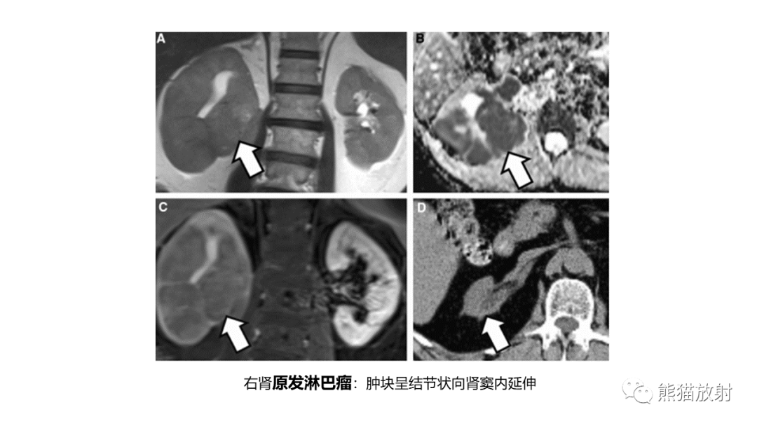 影像PPT - 【PPT】肾窦病变影像诊断思路-48