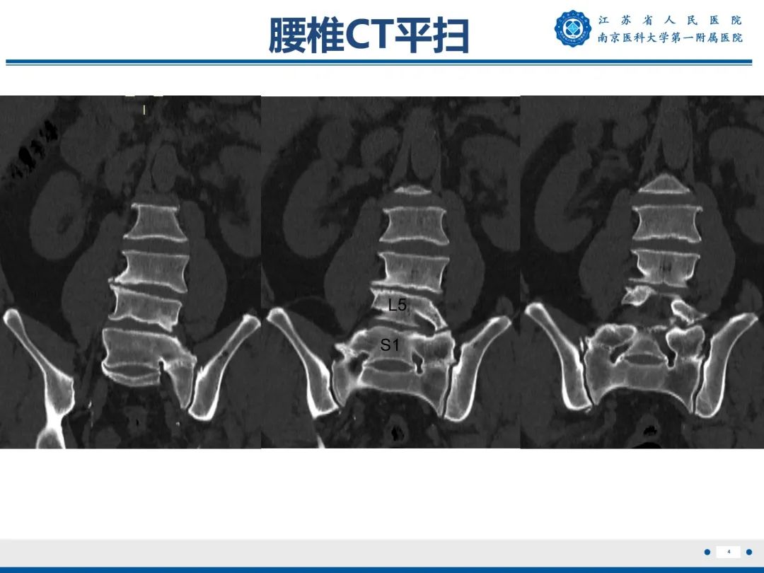 影像PPT - 【PPT】Bertolotti 综合征-5