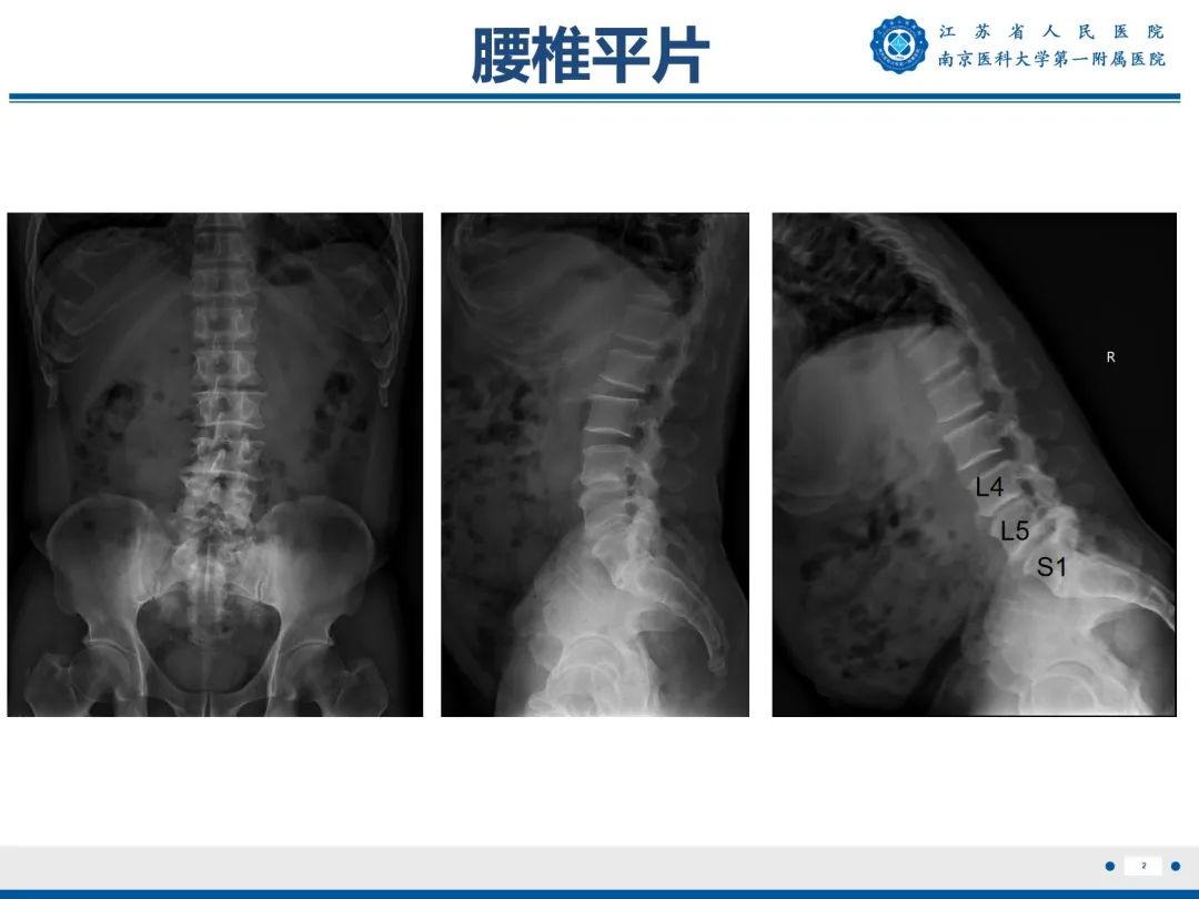 影像PPT - 【PPT】Bertolotti 综合征-3
