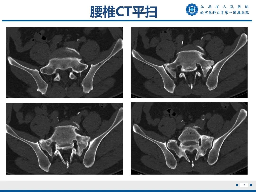 影像PPT - 【PPT】Bertolotti 综合征-4