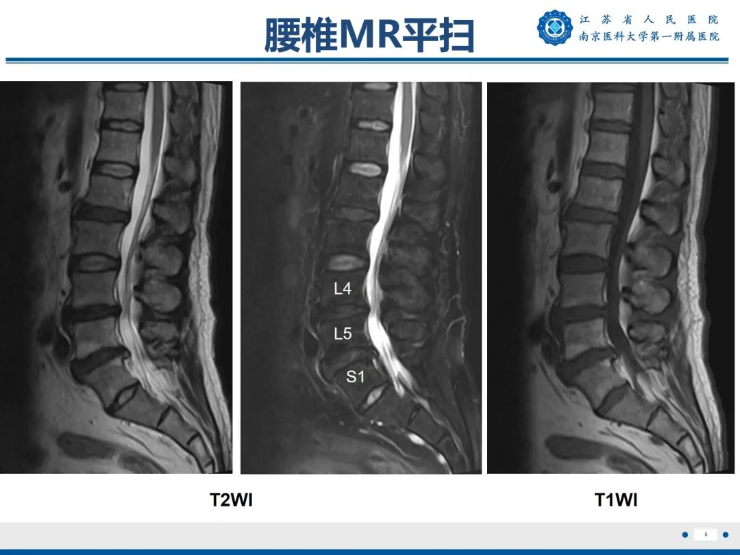 影像PPT - 【PPT】Bertolotti 综合征-6