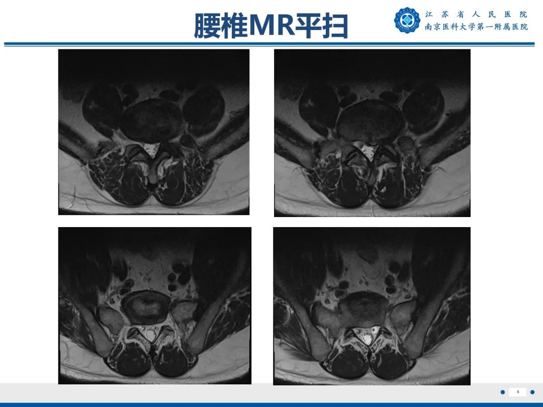 影像PPT - 【PPT】Bertolotti 综合征-7