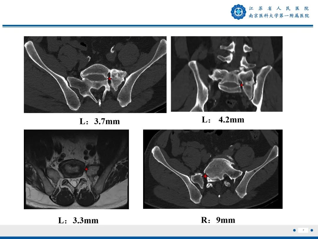 影像PPT - 【PPT】Bertolotti 综合征-8