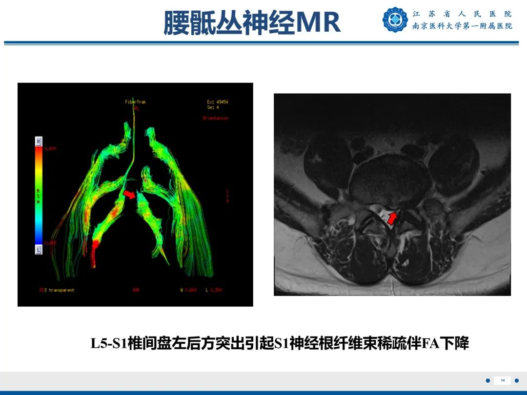 影像PPT - 【PPT】Bertolotti 综合征-15