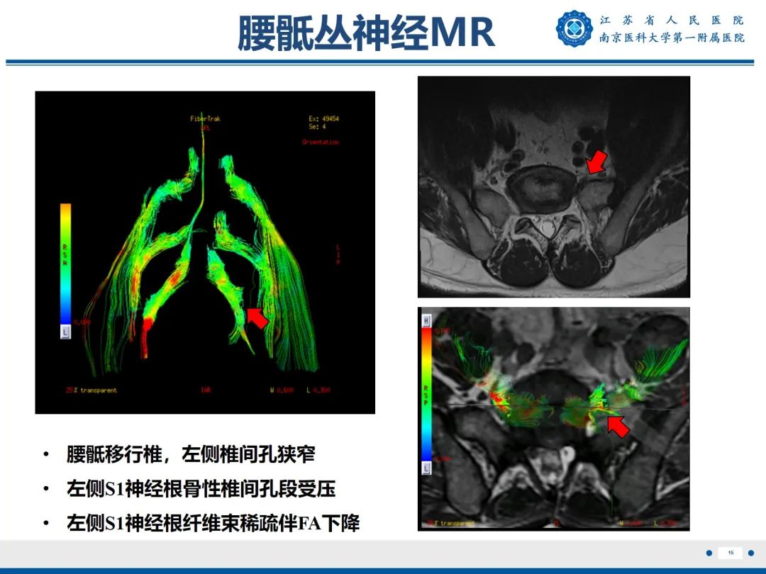影像PPT - 【PPT】Bertolotti 综合征-16