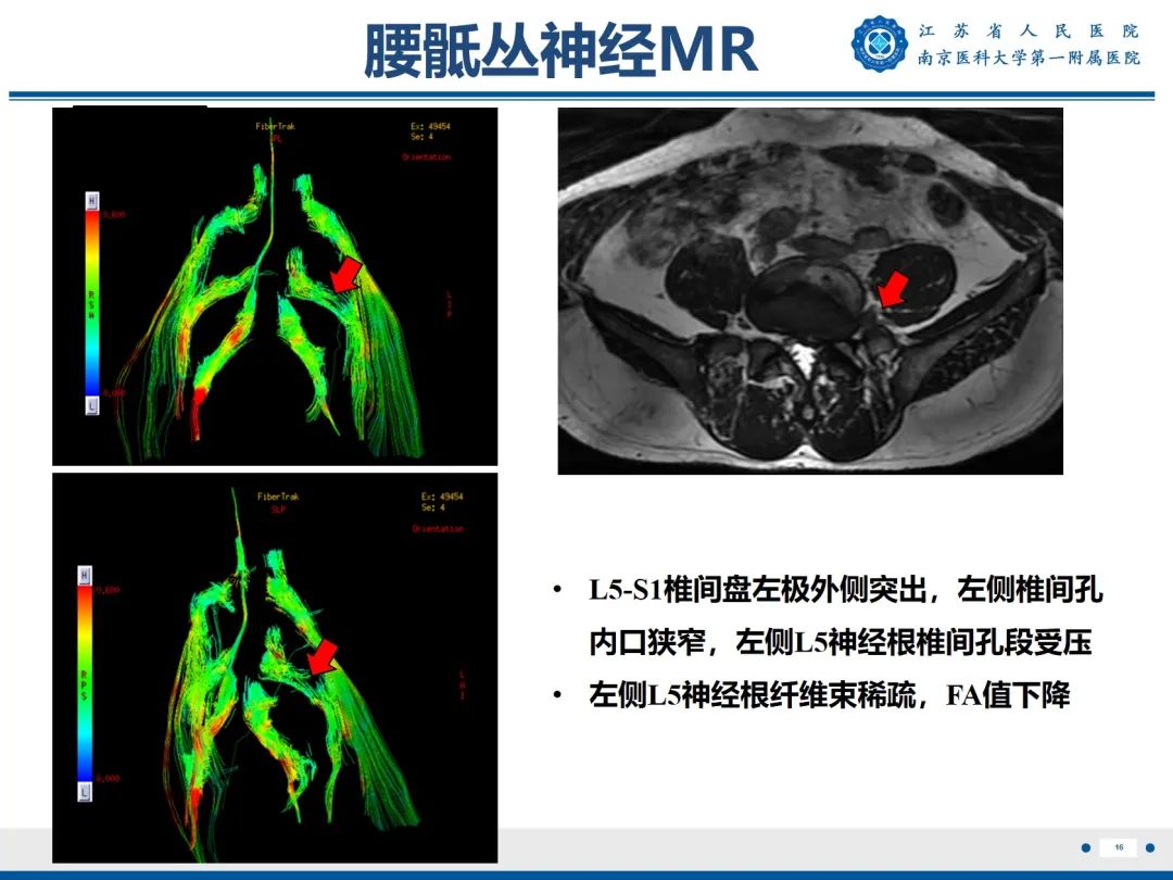 影像PPT - 【PPT】Bertolotti 综合征-17