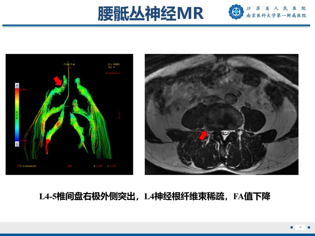 影像PPT - 【PPT】Bertolotti 综合征-18