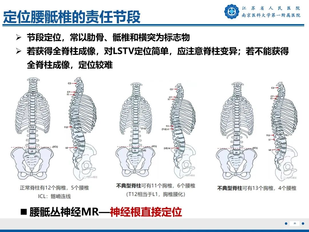 影像PPT - 【PPT】Bertolotti 综合征-26