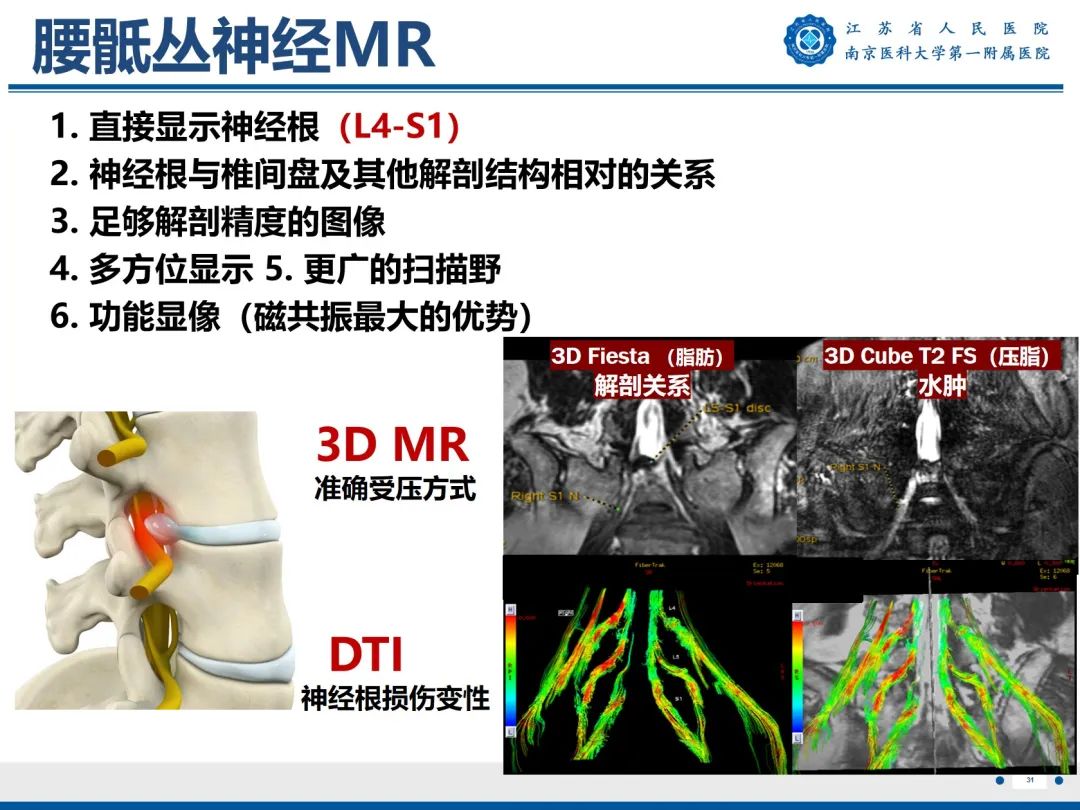 影像PPT - 【PPT】Bertolotti 综合征-32