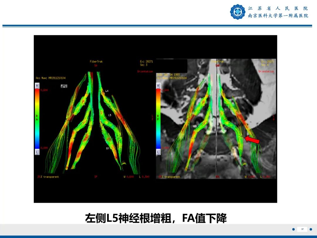 影像PPT - 【PPT】Bertolotti 综合征-38
